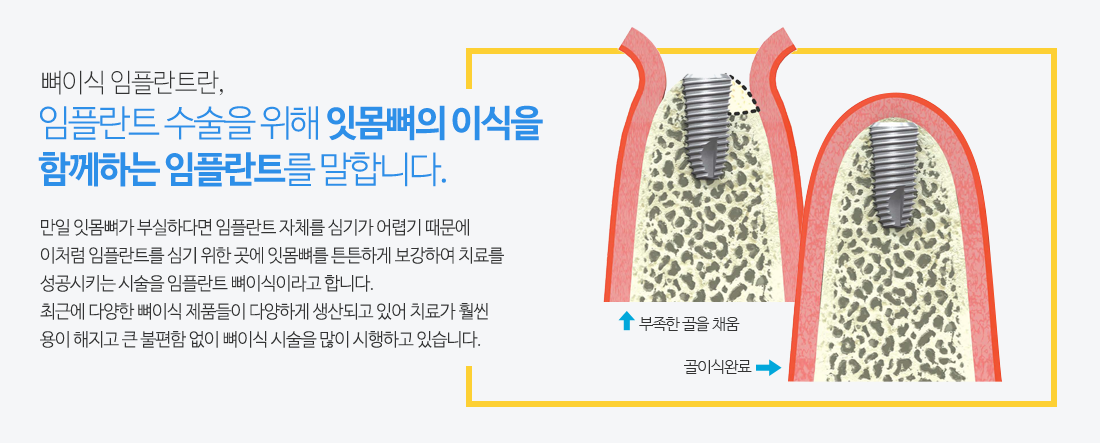 뼈이식임플란트설명