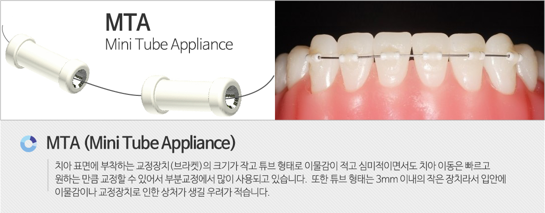 패스트앞니교정이란
